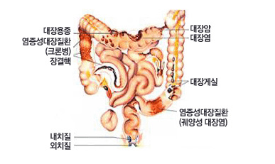 대장내시경으로 진단할 수 있는 질환