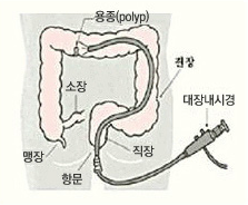 대장에 생긴 용종