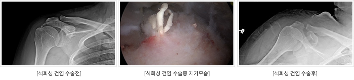석회성건염