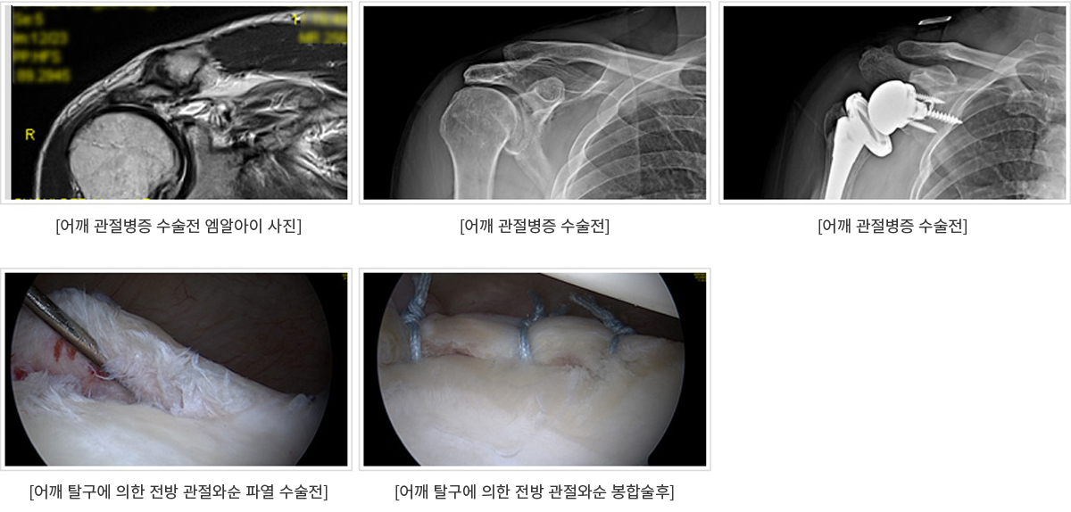 어깨관절탈구